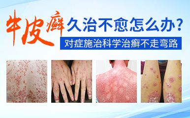 南京治银屑病好医院-怎么保健调理牛皮癣皮肤病