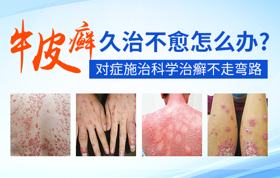 小儿牛皮癣多久能治好 牛皮癣能治好吗